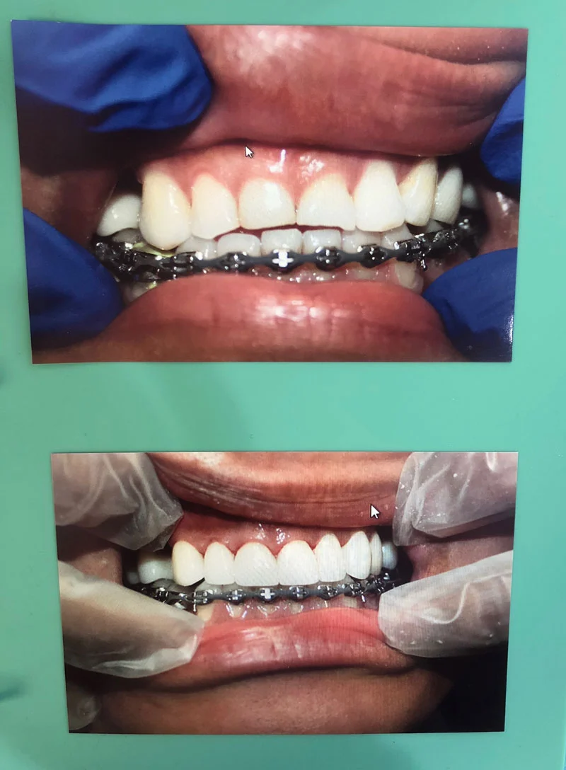 Veneer Teeth- Pure Smile Dental Group