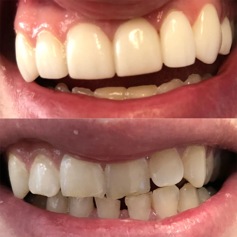 Veneer Teeth- Pure Smile Dental Group