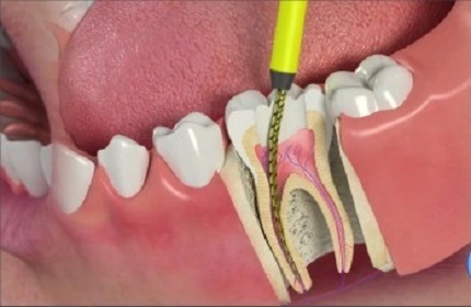 Root Canal Treatment । Pure Smile Dental Group